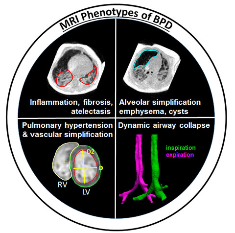 MRI Phenotypes of BPD